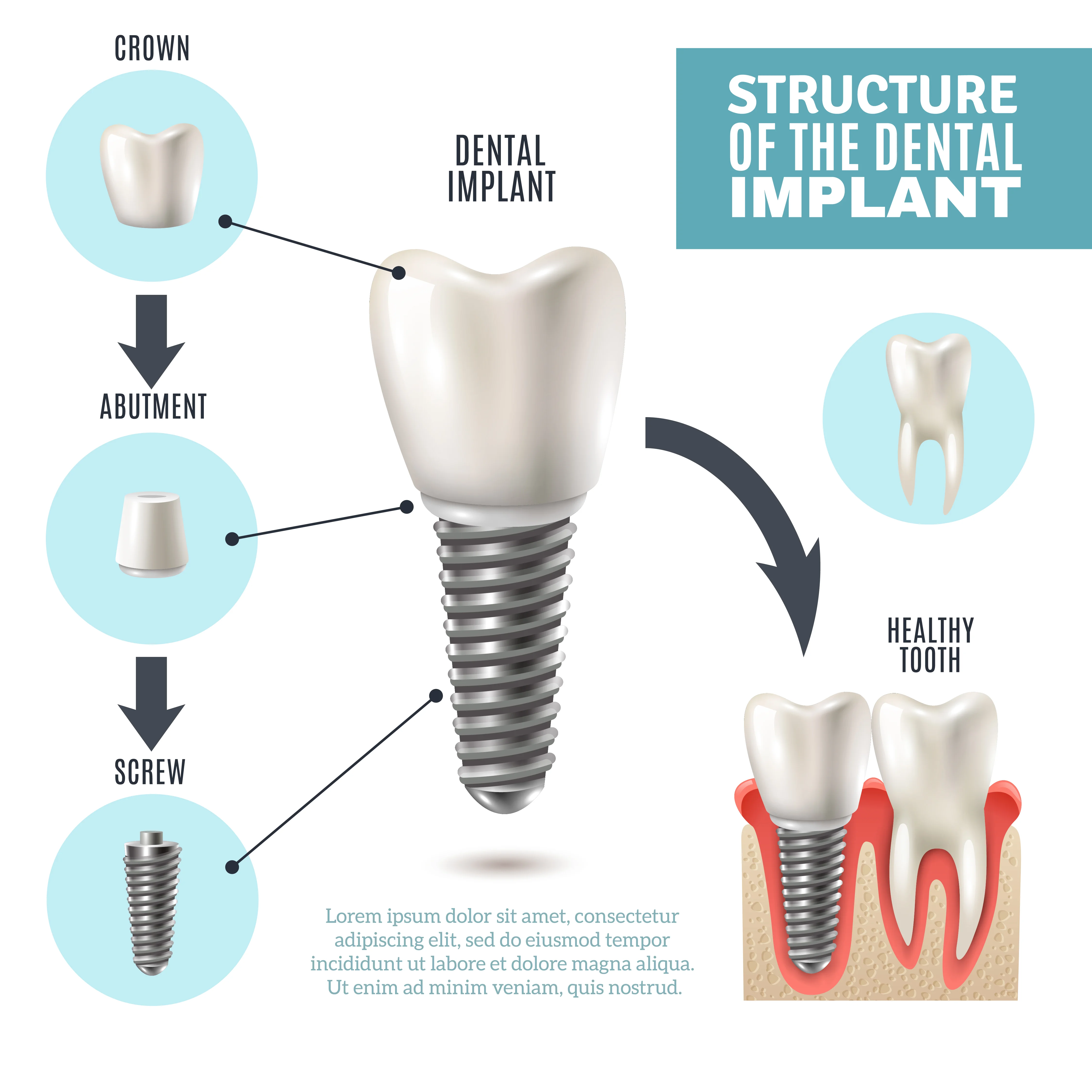 Dental implant treatment area at Narayani Dental Care