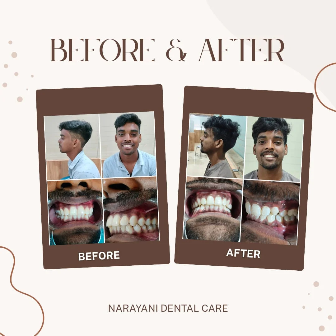 Before and after braces treatment at Narayani Dental Care
