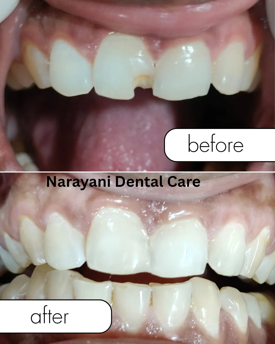 Before and after dental restoration at Narayani Dental Care