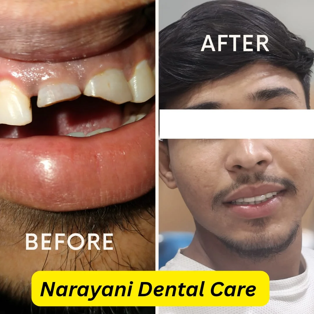 Before and after dental implant at Narayani Dental Care