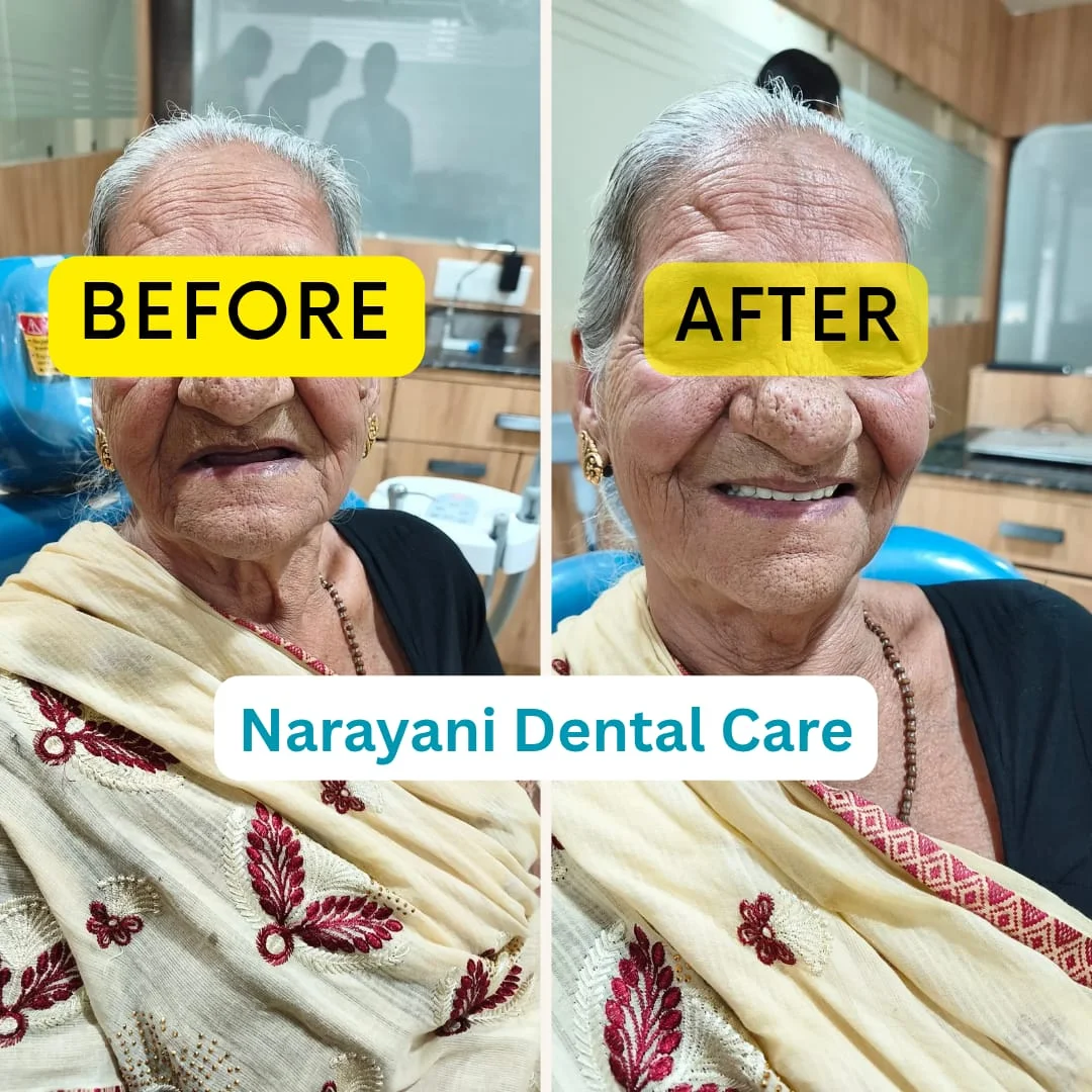 Before and after dentures for elderly patient