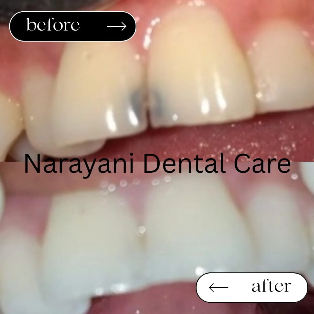Before and after teeth restoration
